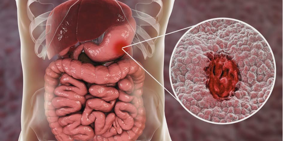 Qué es la inflamación crónica